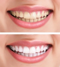 before and after of teeth whitening